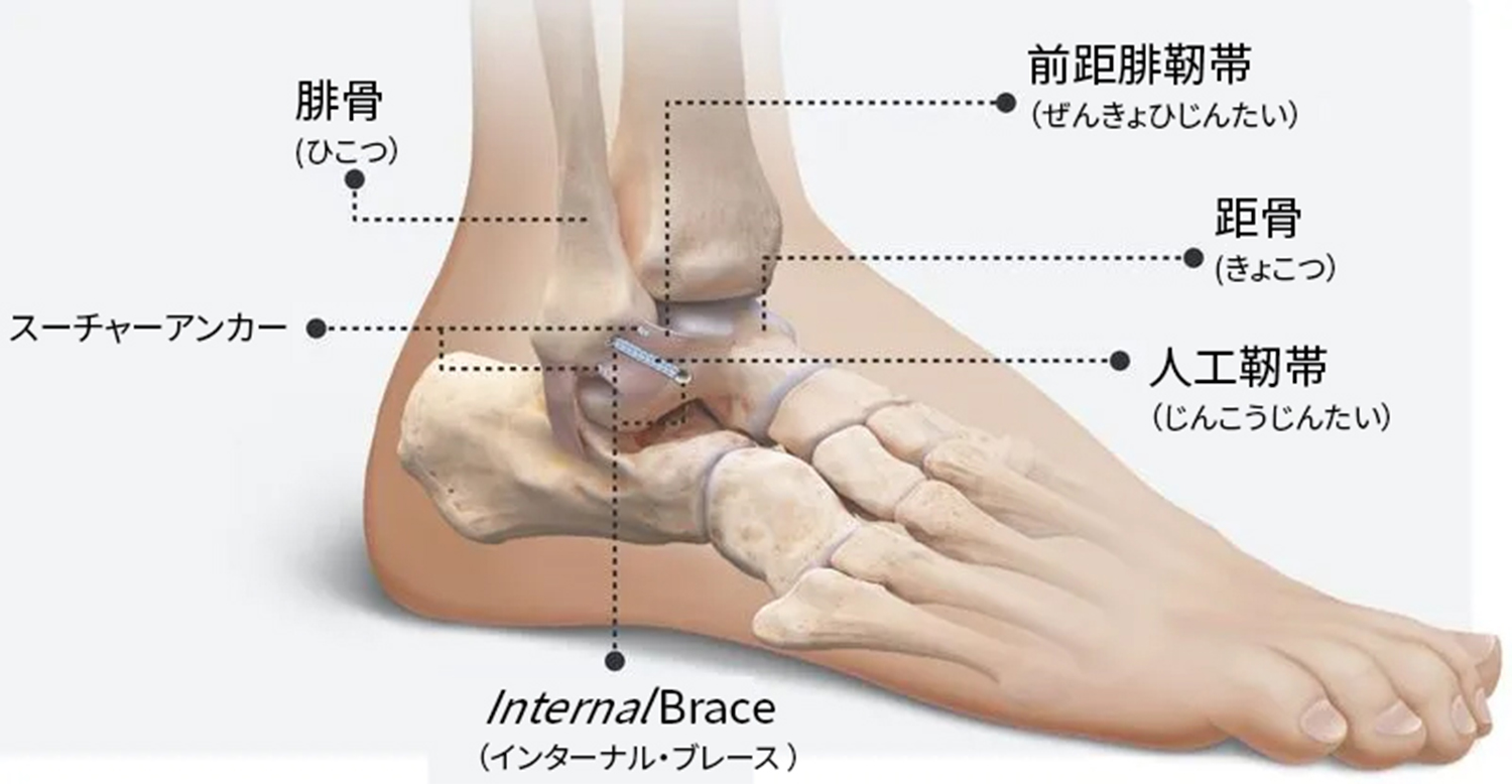 InternalBrace